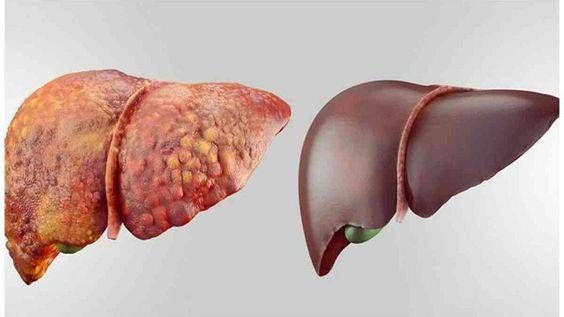 علامات تظهر بالساقين تدل على وجود مشكلة بالكبد 