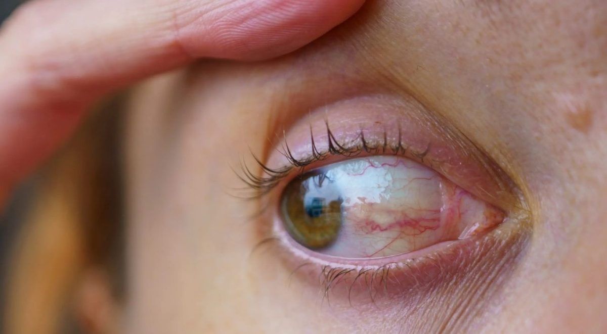 علامات تظهر بالعين تدل على الإصابة بأمراض القلب والأوعية الدموية 