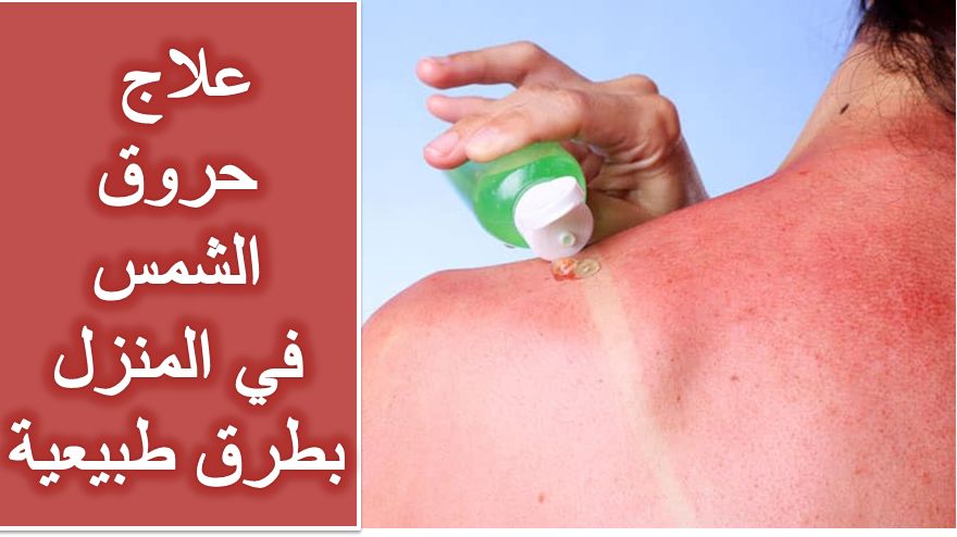 علاج حروق الشمس