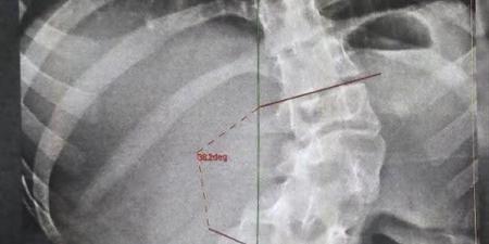 تصحيح شبه كامل لتشوهات العمود الفقري، نجاح جراحة دقيقة لفتاة بمستشفيات بنها الجامعية