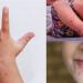 استشاري يكشف أعراض وأسباب متلازمة اليد والقدم والفم عند الأطفال