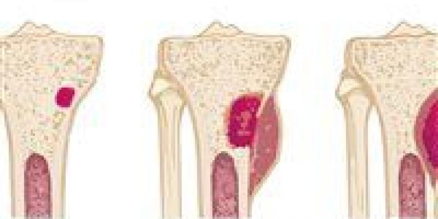 تسوس عظام الأذن خطير أعراضه وعلاجه ومضاعفاته الطبية