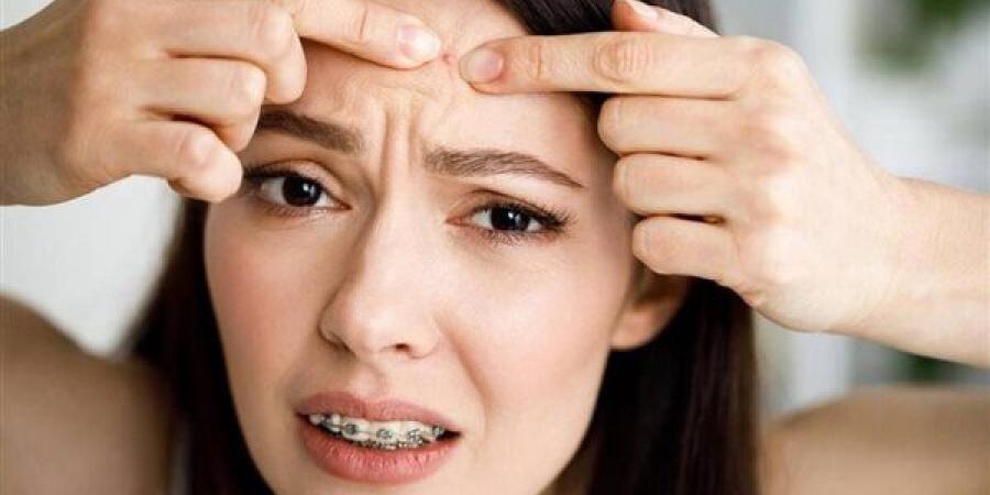 وصفات طبيعية سريعة المفعول لعلاج حبوب الجبهة الصيفية